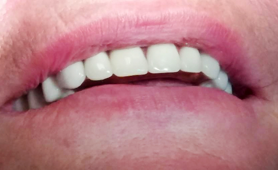 Caz 10 implanturi dentare - dupa