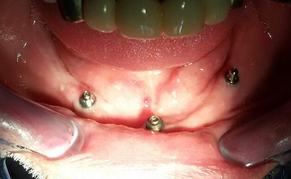 Caz 12 implanturi dentare - inainte