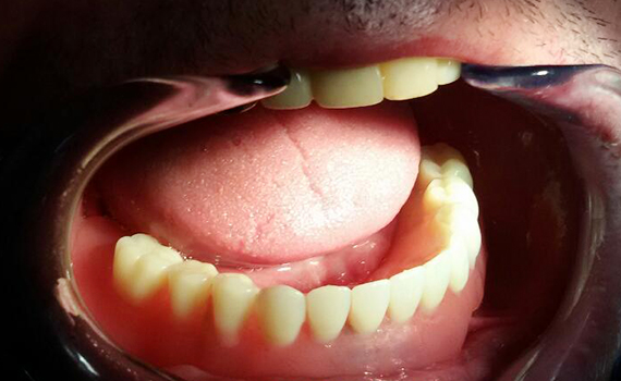 Caz 12 implanturi dentare - dupa