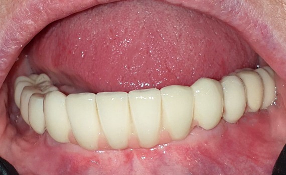 Caz 16 implanturi dentare - dupa