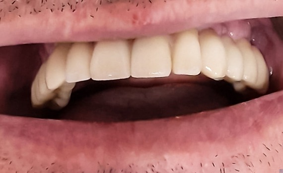 Caz 17 implanturi dentare - dupa