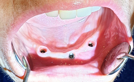 Caz 3 implanturi dentare - inainte