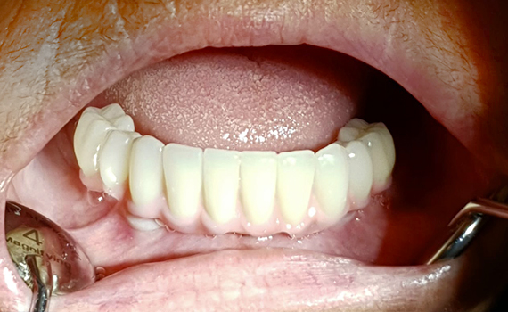 Caz 3 implanturi dentare - dupa