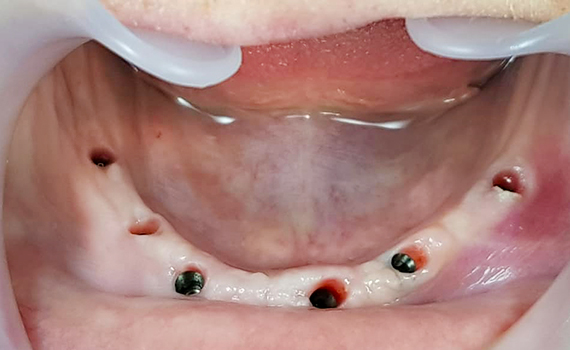 Caz 5 implanturi dentare - inainte