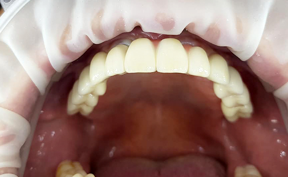 Caz 6 implanturi dentare - dupa