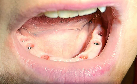 Caz 9 implanturi dentare - inainte