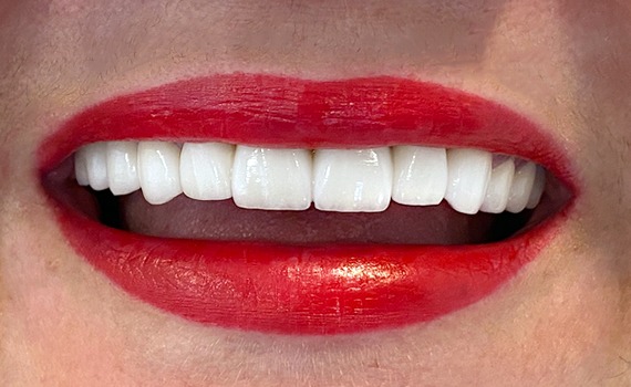 Caz 10 estetica dentara - dupa