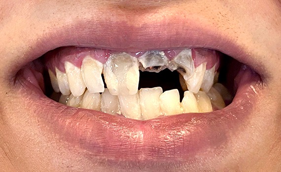 Caz 2 estetica dentara - inainte