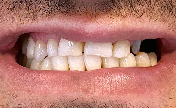 Caz 3 estetica dentara - inainte