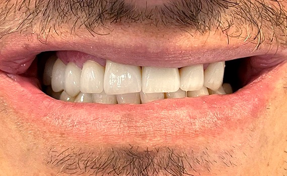 Caz 3 estetica dentara - dupa