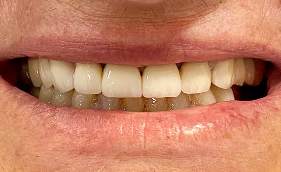 Caz 4 estetica dentara - dupa