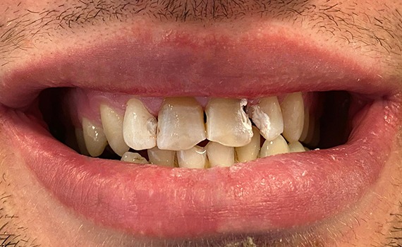 Caz 5 estetica dentara - inainte