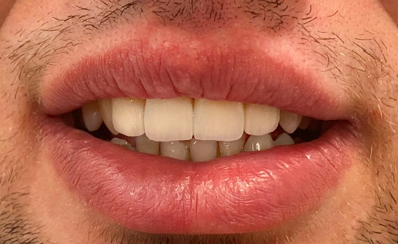 Caz 5 estetica dentara - dupa