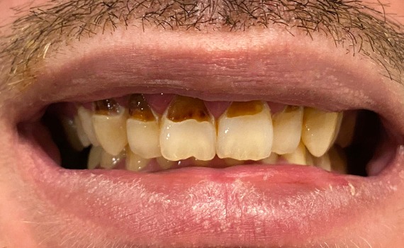 Caz 6 estetica dentara - inainte
