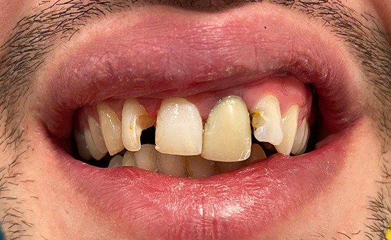 Caz 7 estetica dentara - inainte