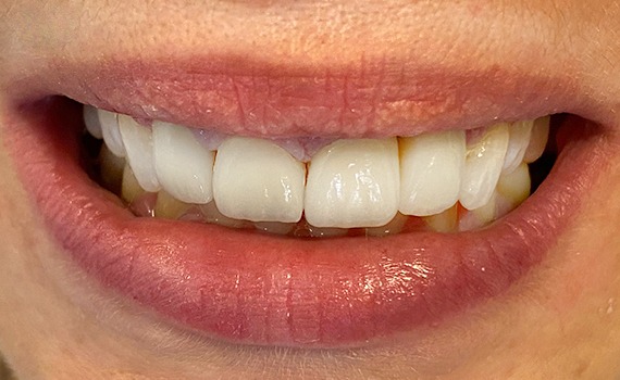 Caz 8 estetica dentara - dupa
