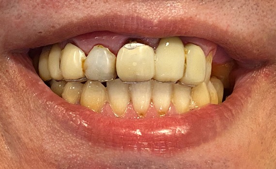 Caz 9 estetica dentara - inainte