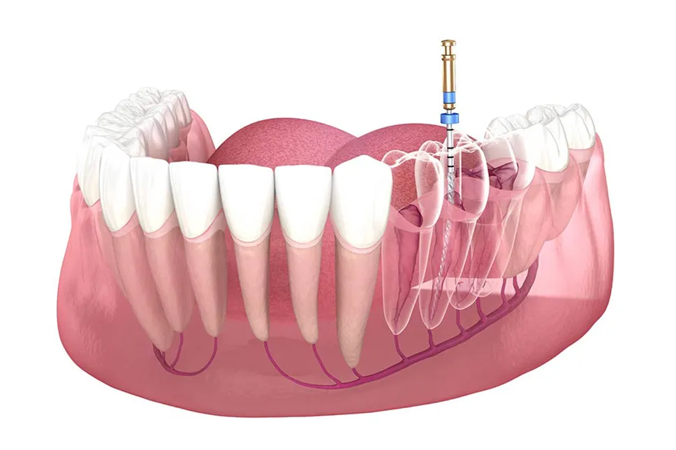 Preparare canal endodontie